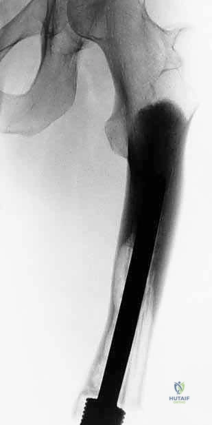 صورة طبية: إنقاذ الأطراف للأطفال زراعة الأطراف الاصطناعية القابلة للتمدد