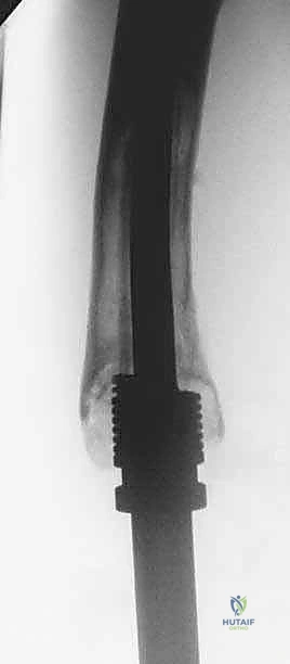 صورة طبية: إنقاذ الأطراف للأطفال زراعة الأطراف الاصطناعية القابلة للتمدد