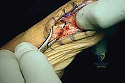 تأثير التشوه على العظام السمسمانية والأنسجة الرخوة