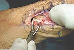 صورة توضيحية لمدى التشوه في مفصل إبهام القدم