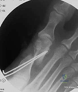 صورة شعاعية توضح تقييم زوايا التشوه