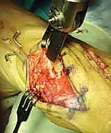 بداية الشق الجراحي والوصول للمفصل