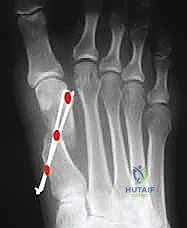 تجهيز المريض وتحديد مكان الشق الجراحي