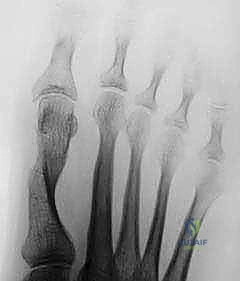 Mastering the Extended Distal Chevron Osteotomy for Hallux Valgus Correction