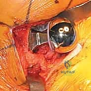 Illustration of hemiarthroplasty of the hip - Dr. Mohammed Hutaif