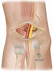 Illustration of reduction of supracondylar - Dr. Mohammed Hutaif