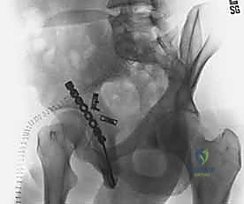 Illustration of posterior wall fractures - Dr. Mohammed Hutaif