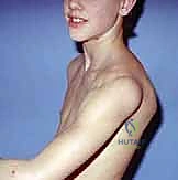 Illustration of instability of the shoulder - Dr. Mohammed Hutaif