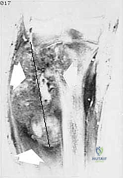 صورة توضيحية لـ بتر الفخذ فوق الركبة الأورامي: دليل شامل للمرضى وخبرة الأستاذ الدكتور محمد هطيف