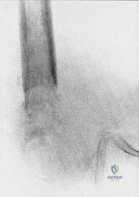 صورة توضيحية لـ بتر الفخذ فوق الركبة الأورامي: دليل شامل للمرضى وخبرة الأستاذ الدكتور محمد هطيف