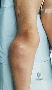 صورة توضيحية لـ بتر الفخذ فوق الركبة الأورامي: دليل شامل للمرضى وخبرة الأستاذ الدكتور محمد هطيف