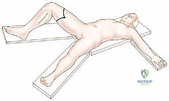 صورة توضيحية لـ بتر الفخذ فوق الركبة الأورامي: دليل شامل للمرضى وخبرة الأستاذ الدكتور محمد هطيف