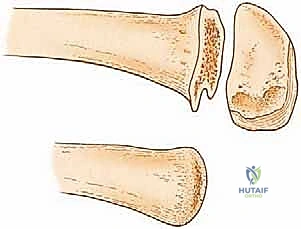 صورة توضيحية لـ بتر الفخذ فوق الركبة الأورامي: دليل شامل للمرضى وخبرة الأستاذ الدكتور محمد هطيف