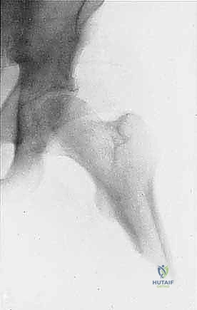 صورة توضيحية لـ بتر الفخذ فوق الركبة الأورامي: دليل شامل للمرضى وخبرة الأستاذ الدكتور محمد هطيف