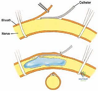صورة طبية: بتر الفخذ فوق الركبة الأورامي: دليل شامل للمرضى وخبرة الأستاذ الدكتور محمد هطيف