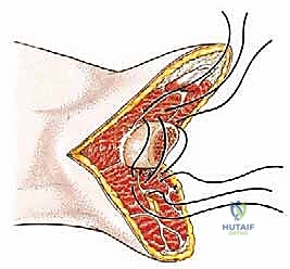 صورة طبية: بتر الفخذ فوق الركبة الأورامي: دليل شامل للمرضى وخبرة الأستاذ الدكتور محمد هطيف