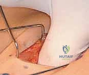صورة توضيحية لـ تشنجات الورك لدى الأطفال: دليل شامل لإطالة العضلة الحرقفية القطنية والعضلات المقربة مع الأستاذ الدكتور محمد هطيف