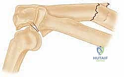Mastering Monteggia Fracture-Dislocations in Adults: An Intraoperative Guide