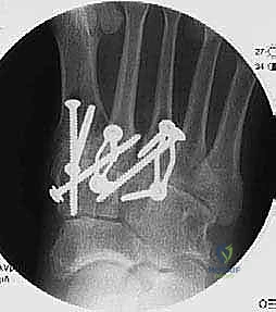 Tarsometatarsal Arthrodesis: An Intraoperative Masterclass for Midfoot Fusion