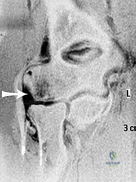 اختبار Pivot-Shift السريري
