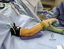 صورة توضيحية لـ إعادة بناء الرباط الجانبي الوحشي للمرفق مع الأستاذ الدكتور محمد هطيف