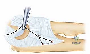 صورة توضيحية لـ إعادة بناء الرباط الجانبي الوحشي للمرفق مع الأستاذ الدكتور محمد هطيف