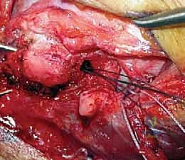 صورة طبية: إعادة بناء الرباط الجانبي الوحشي للمرفق مع الأستاذ الدكتور محمد هطيف