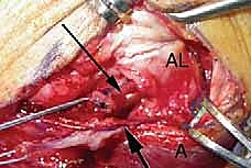 صورة توضيحية لـ إعادة بناء الرباط الجانبي الوحشي للمرفق مع الأستاذ الدكتور محمد هطيف