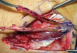 صورة طبية: إعادة بناء الرباط الجانبي الوحشي للمرفق مع الأستاذ الدكتور محمد هطيف
