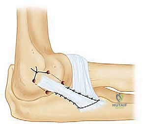 صورة طبية: إعادة بناء الرباط الجانبي الوحشي للمرفق مع الأستاذ الدكتور محمد هطيف