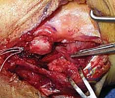 صورة طبية: إعادة بناء الرباط الجانبي الوحشي للمرفق مع الأستاذ الدكتور محمد هطيف