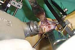 Ace Your FRCS Oral: Monteggia Fractures Trauma Case Guide