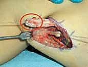 Illustration of rectus femoris muscle - Dr. Mohammed Hutaif