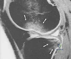 موقع الرباط الصليبي داخل الركبة