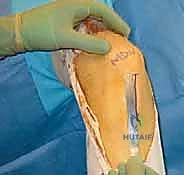 آلية تمزق الرباط الصليبي