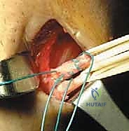 اختبار لاكمان السريري