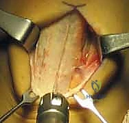 فحص عدم استقرار الركبة