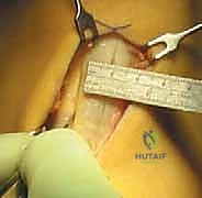 تورم الركبة بعد الإصابة