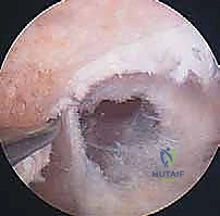 طعم الوتر الرضفي