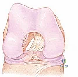 إعادة بناء الرباط الصليبي الأمامي: دليلك الشامل لركبة قوية مع الأستاذ الدكتور محمد هطيف