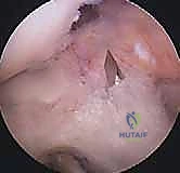 صورة توضيحية لـ إعادة بناء الرباط الصليبي الأمامي: دليلك الشامل لركبة قوية مع الأستاذ الدكتور محمد هطيف