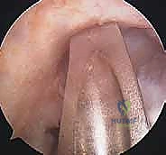 صورة توضيحية لـ إعادة بناء الرباط الصليبي الأمامي: دليلك الشامل لركبة قوية مع الأستاذ الدكتور محمد هطيف