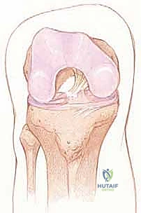 صورة طبية: إعادة بناء الرباط الصليبي الأمامي: دليلك الشامل لركبة قوية مع الأستاذ الدكتور محمد هطيف
