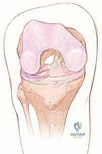 صورة توضيحية لـ إعادة بناء الرباط الصليبي الأمامي: دليلك الشامل لركبة قوية مع الأستاذ الدكتور محمد هطيف