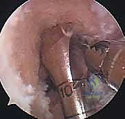 صورة توضيحية لـ إعادة بناء الرباط الصليبي الأمامي: دليلك الشامل لركبة قوية مع الأستاذ الدكتور محمد هطيف