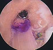 صورة طبية: إعادة بناء الرباط الصليبي الأمامي: دليلك الشامل لركبة قوية مع الأستاذ الدكتور محمد هطيف