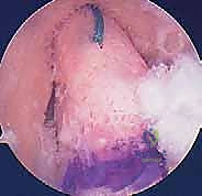 صورة طبية: إعادة بناء الرباط الصليبي الأمامي: دليلك الشامل لركبة قوية مع الأستاذ الدكتور محمد هطيف
