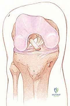 صورة توضيحية لـ إعادة بناء الرباط الصليبي الأمامي: دليلك الشامل لركبة قوية مع الأستاذ الدكتور محمد هطيف