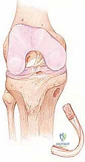 صورة طبية: إعادة بناء الرباط الصليبي الأمامي: دليلك الشامل لركبة قوية مع الأستاذ الدكتور محمد هطيف