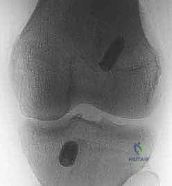 صورة توضيحية لـ إعادة بناء الرباط الصليبي الأمامي: دليلك الشامل لركبة قوية مع الأستاذ الدكتور محمد هطيف